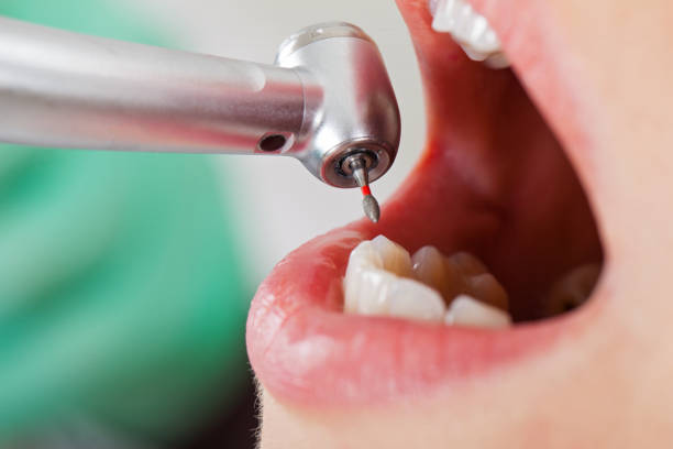 Best Emergency Dental Care for Broken or Chipped Teeth in Smithfield, VA
